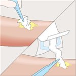 MESALT 10CM X 10CM  30/6BX/CS