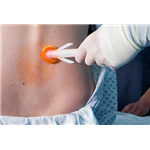 Chloraprep Applicator 3ml 25/4BX/CS