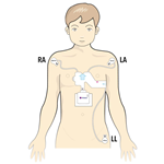 PCA 300T 12-Lead ECG QHeart Sensor